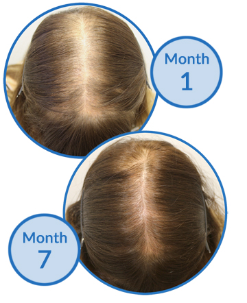 Female Pattern Hair Loss and Traction Alopecia Treatment hair growth Belgravia Centre Success Story