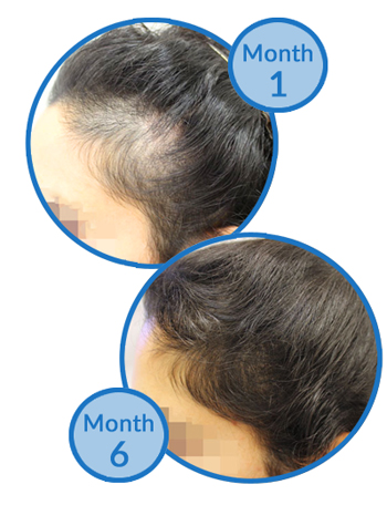 Belgravia Centre Telogen Effluvium Treatment Client Hair Loss Success Story -