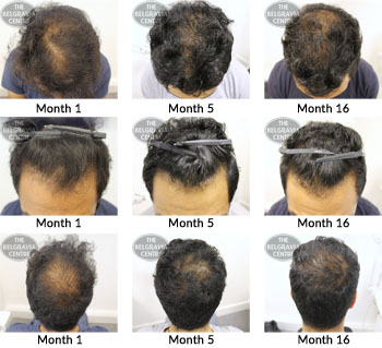 alert male pattern hair loss the belgravia centre 21 07 17