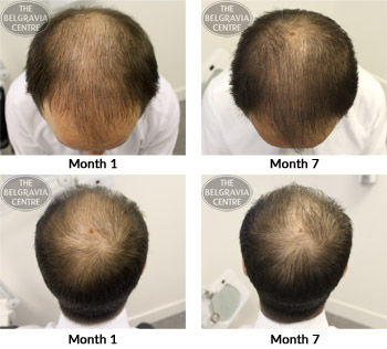 alert male pattern hair loss the belgravia centre 19 07 17