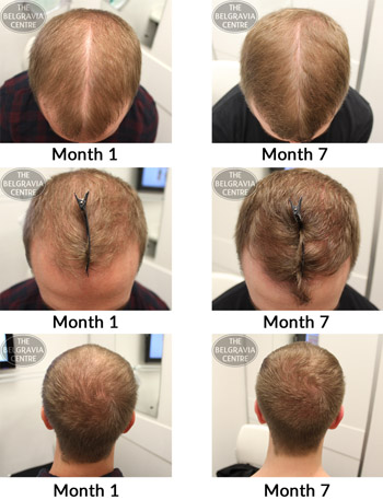 alert male pattern hair loss the belgravia centre 17 07 17