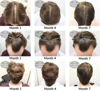 alert male pattern hair loss the belgravia centre 14 07 17