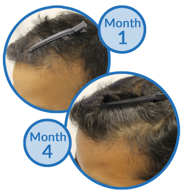 Receding Hairline Asian Hair Growth Hair Loss Treatment Belgravia Centre Client Success Story