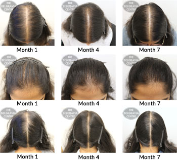 alert female pattern hair loss the belgravia centre 03 07 17