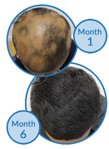 Regrowth Success Story - Alopecia Areata Treatment at The Belgravia Centre
