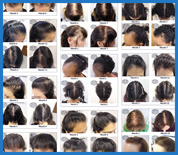 Women's Hair Loss Success Stories Large Photo