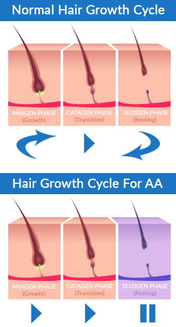 Normal Hair Growth Cycle versus Hair Growth in Alopecia Areata