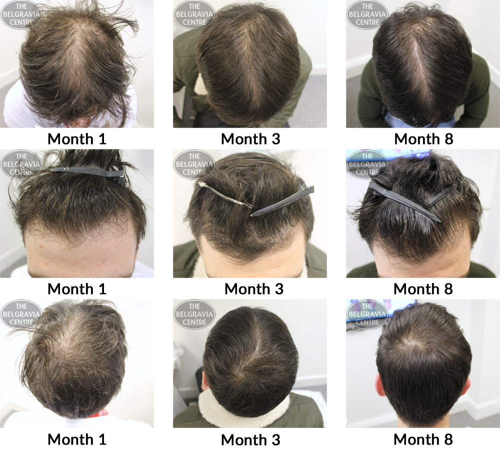 male pattern hair loss the belgravia centre 15 05 17