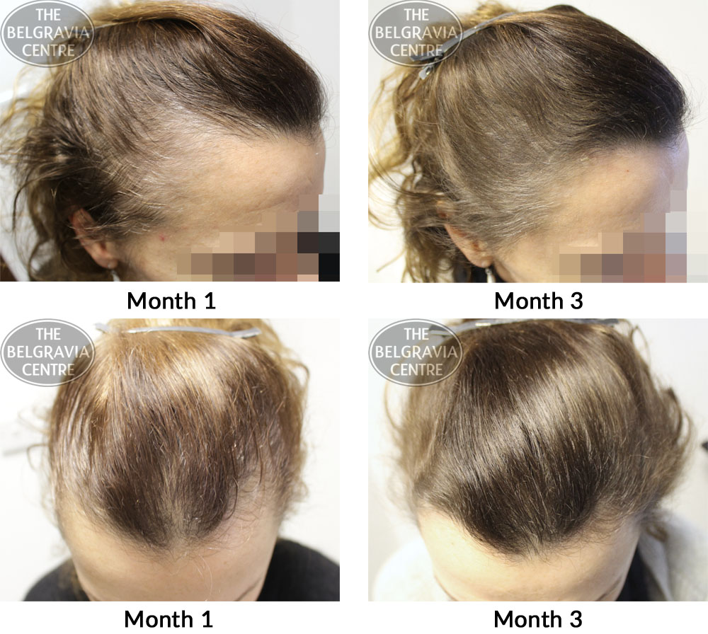 female pattern hair loss the belgravia centre 08 05 17