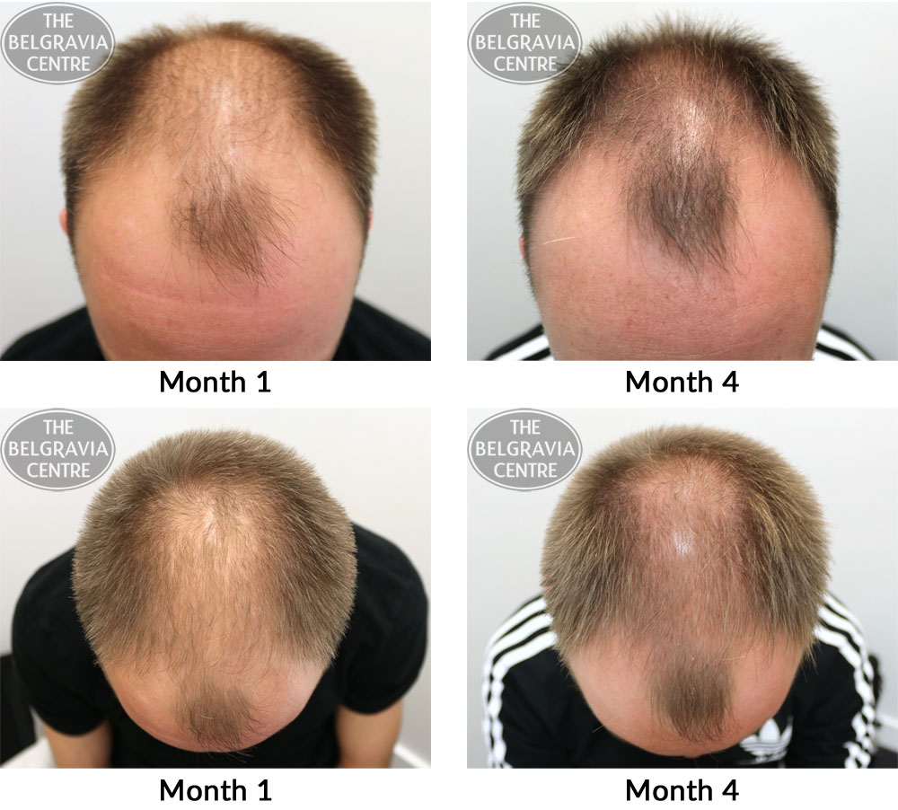 male pattern hair loss the belgravia centre 05 05 2017