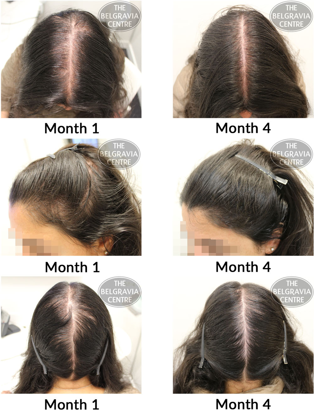 female pattern hair loss the belgravia centre 25 04 17