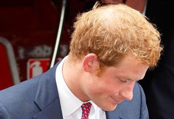 Has Prince Harry Been Using Hair Loss Treatments?
