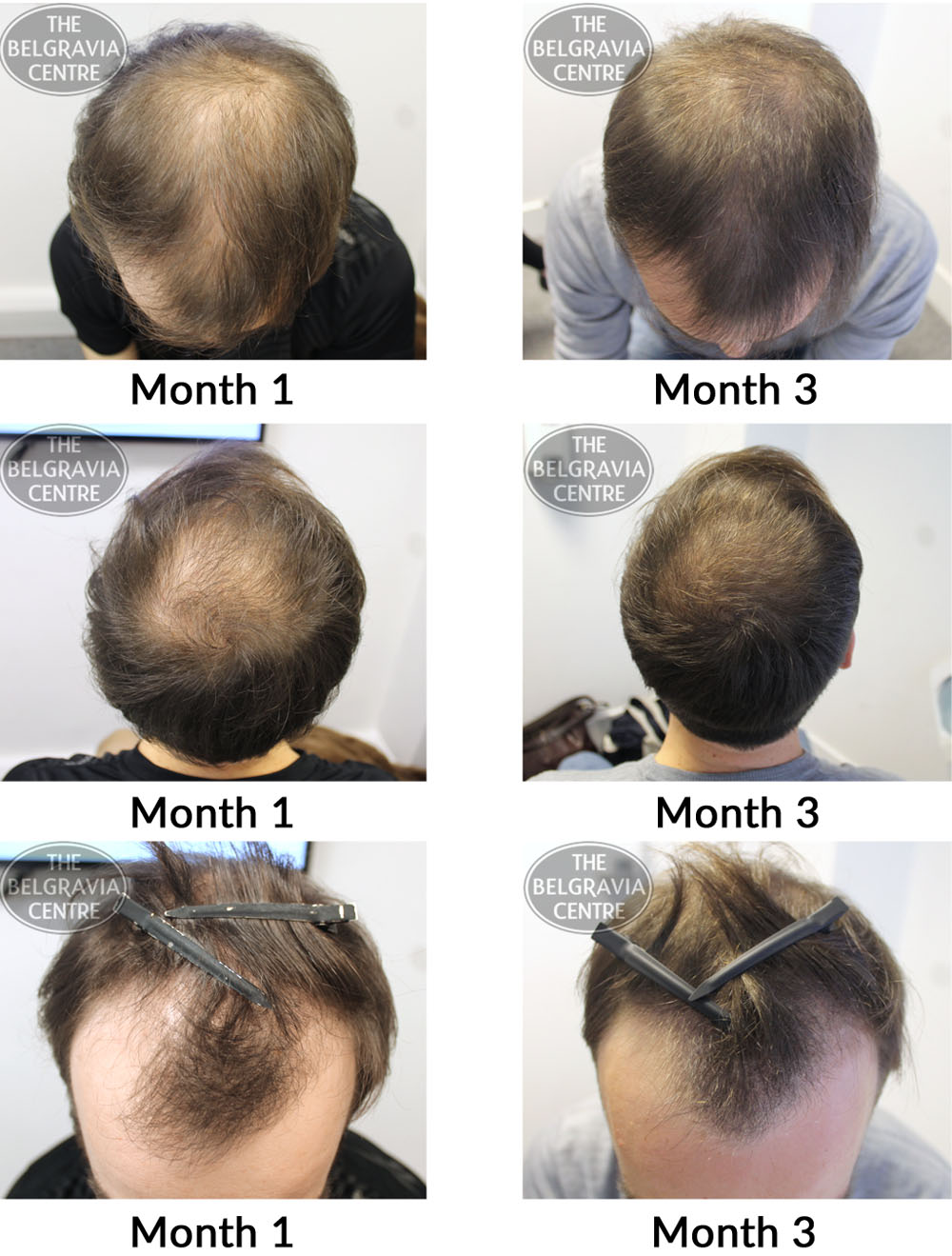 male pattern hair loss the belgravia centre 21 04 17