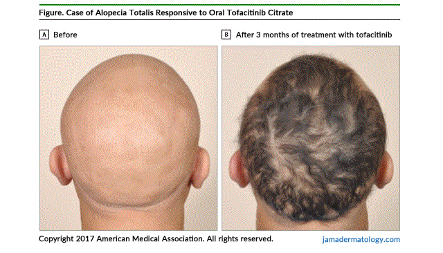 Tofacitinib Citrate Xeljanz Treatment for Alopecia Totalis