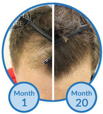 belgravia-centre-receding-hairline-treatment-client-success-story