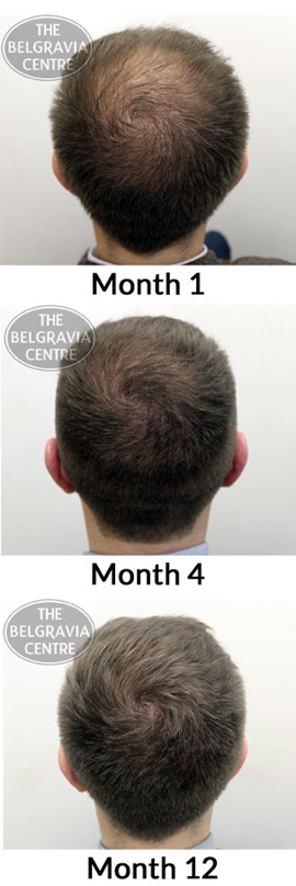 Thinning Crown Regrowth Belgravia Client Hair Loss Treatment Success Story