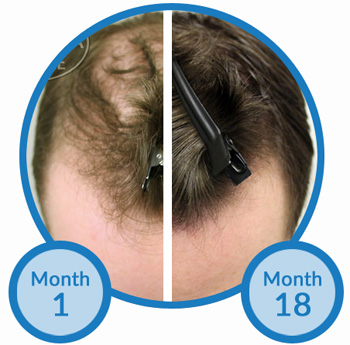 Receding Hairline Regrowth - Click for Further Details