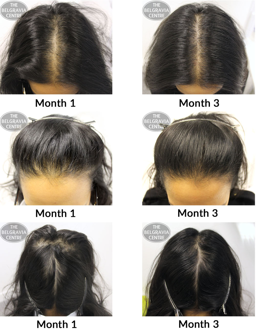female pattern hair loss the belgravia centre 06 03 2017