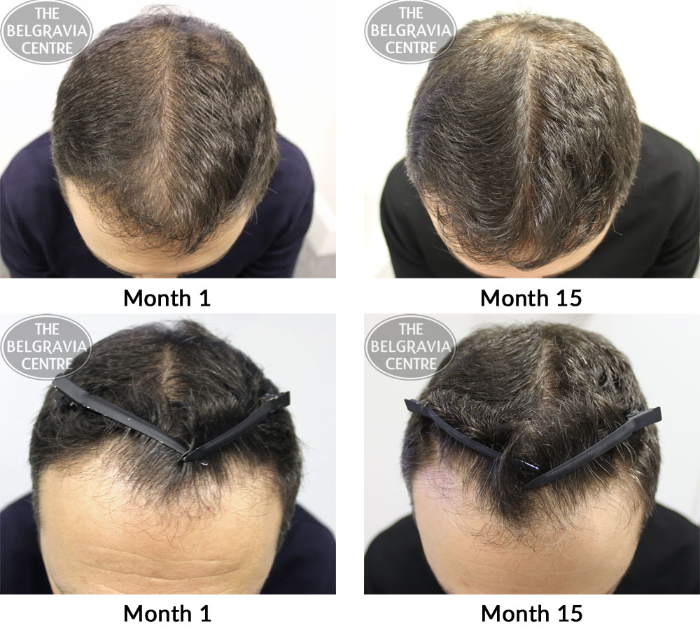 male pattern hair loss the belgravia centre 03 03 17