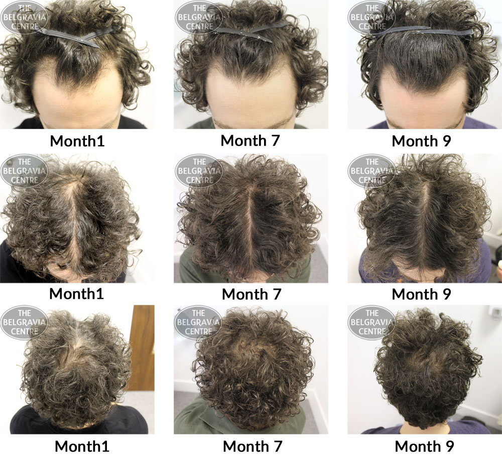 male pattern hair loss the belgravia centre 20 02 2017