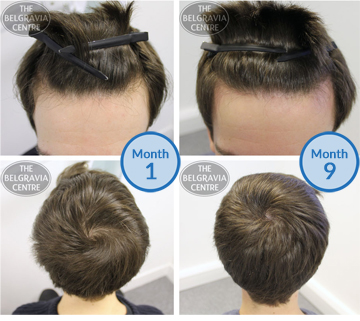 Treatment for Hair Loss Prevention - The Belgravia Centre Client Success Story