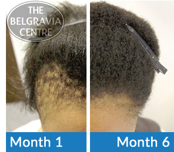 Belgravia Centre Client Before and After Starting Treatment for Traction Alopecia Hair Loss