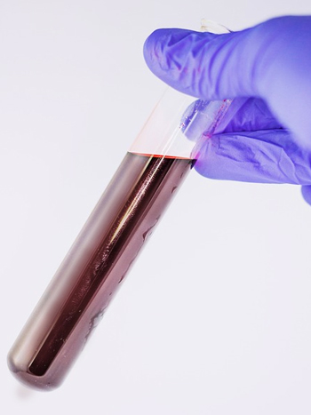 Lipid profile iron levels blood test