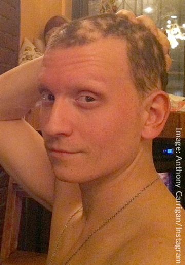Anthony Carrigan With Hair Alopecia Areata Bald Spots