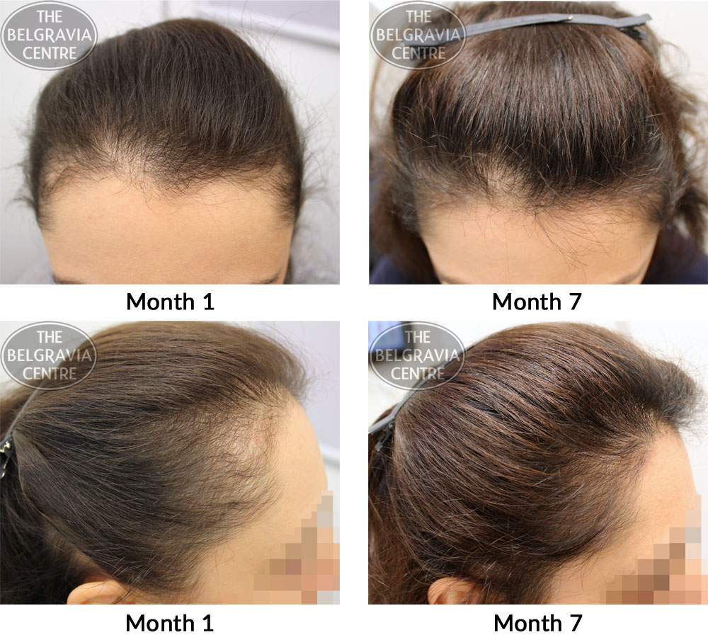 Success Story Alert! New Female Hair Loss Treatment Entry
