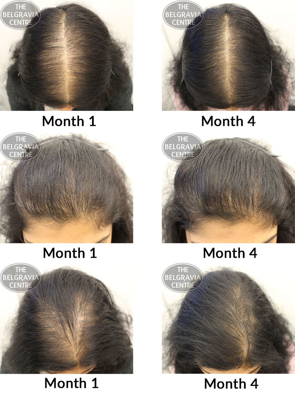 female pattern hair loss the belgravia centre 16 01 2017 2