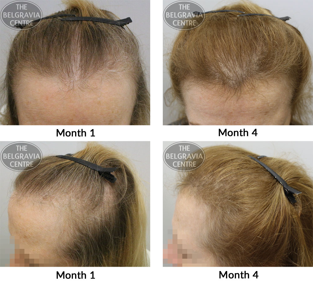 female pattern hair loss the belgravia centre 06 01 17