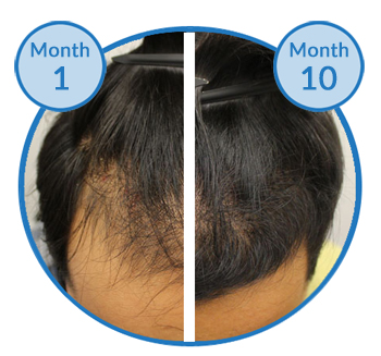 belgravia-male-hair-loss-treatment-success-story-client-before-and-after