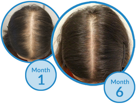 Success Story - Belgravia Centre Diffuse Thinning and Female Pattern Hair Loss Treatment