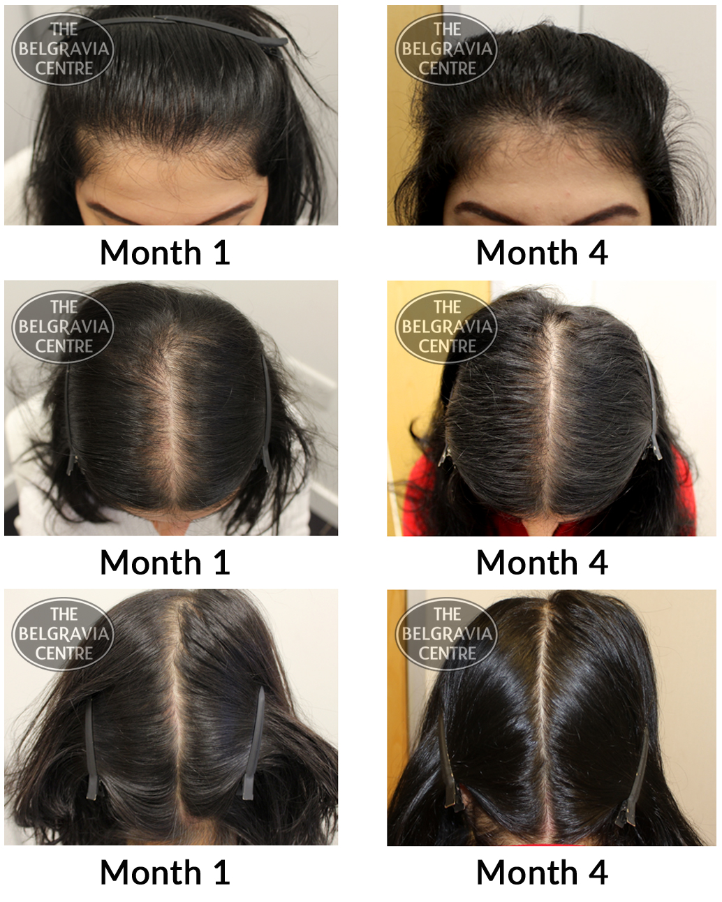 Success Story Alert! New Female Pattern Hair Loss Treatment Entry