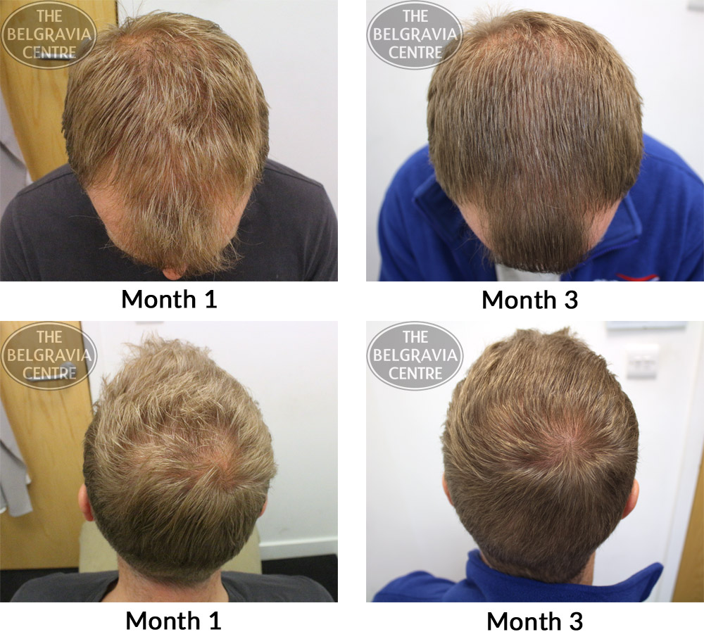 male-pattern-hair-loss-the-belgravia-centre-22-11