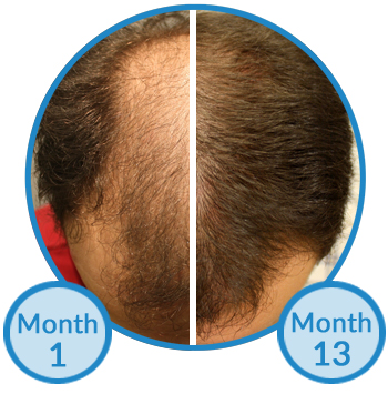 Will Minoxidil Regrow Hair on Bald Areas?'