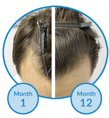Receding Hairline Regrowth Belgravia Centre Hair Loss Treatment Success Story