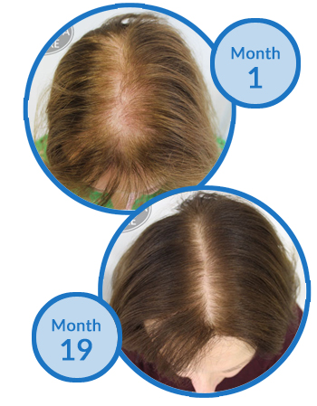 Belgravia Centre Female Pattern Hair Loss Treatment Client Before and After Success Story