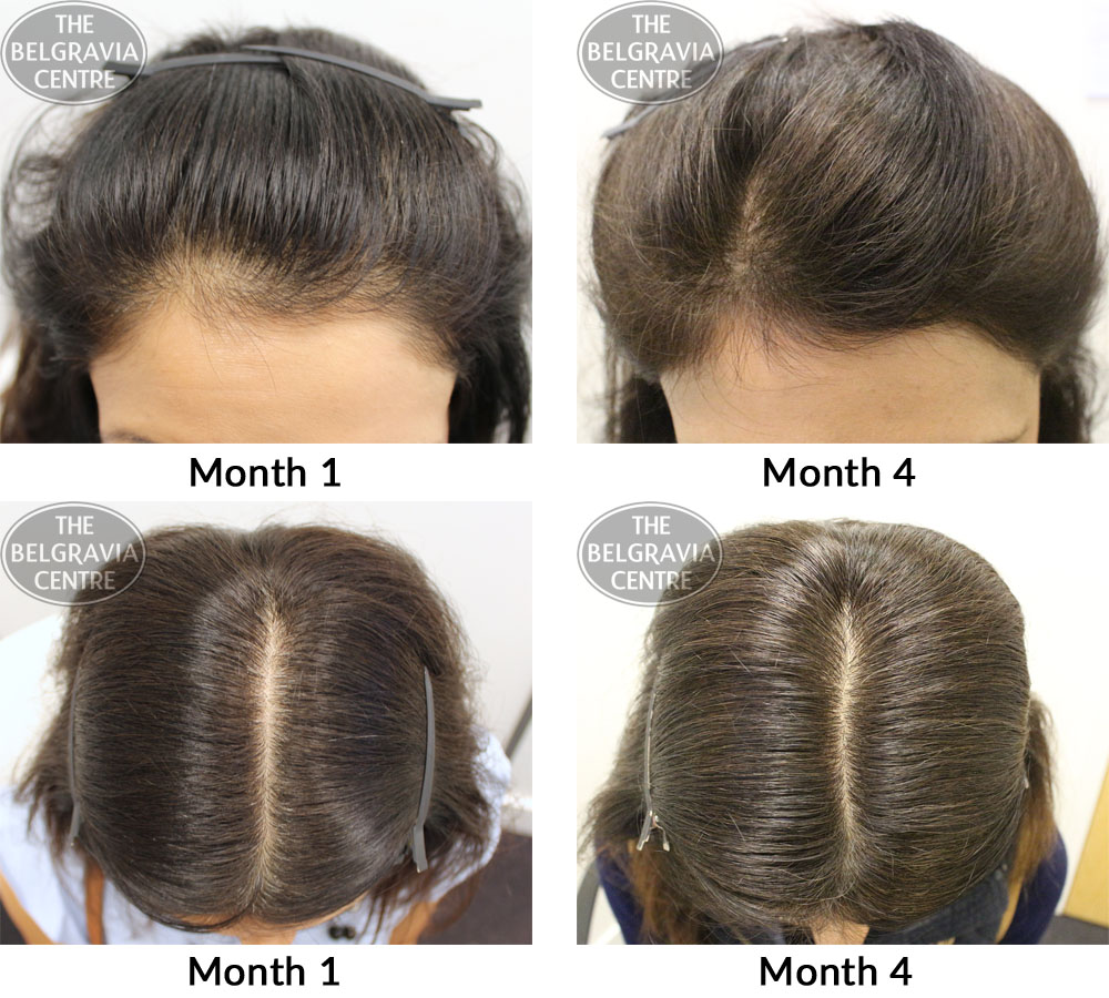 female-patttern-hair-loss-telogen-effluvium-the-belgravia-centre-10-11