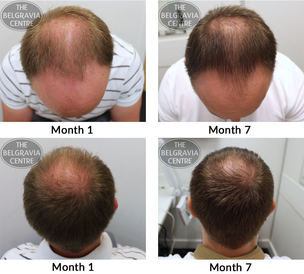 male-pattern-hair-loss-the-belgravia-centre-07-11