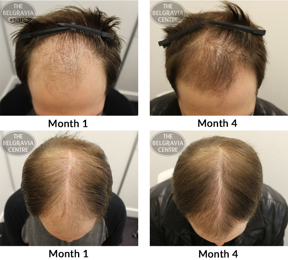 male-pattern-hair-loss-the-belgravia-centre-04-11