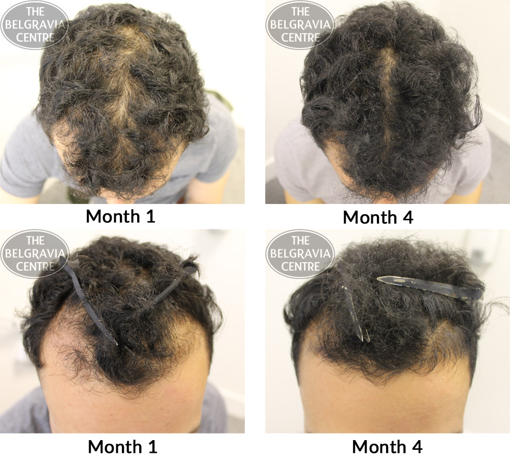 male-pattern-hair-loss-the-belgravia-centre-02-11