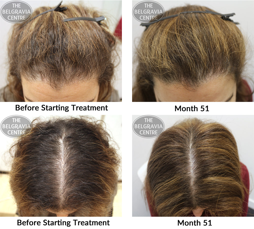 female-pattern-hair-loss-the-belgravia-centre-01-11