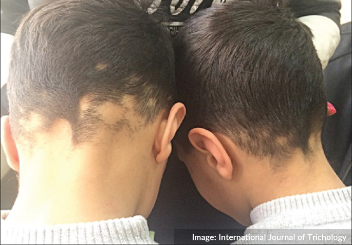 two-episodes-of-simultaneous-identical-alopecia-areata-in-identical-twins