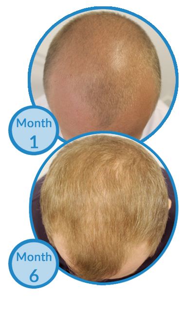 Belgravia Centre client male pattern hair loss treatment results