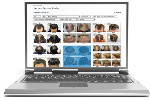 Belgravia Centre Hair Loss Clinic Launches Success Stories Before and After Photo Gallery with Results You Can Search by Condition or Regrowth