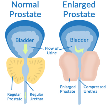 prostate-diagram-enlarged-prostate-hair-loss
