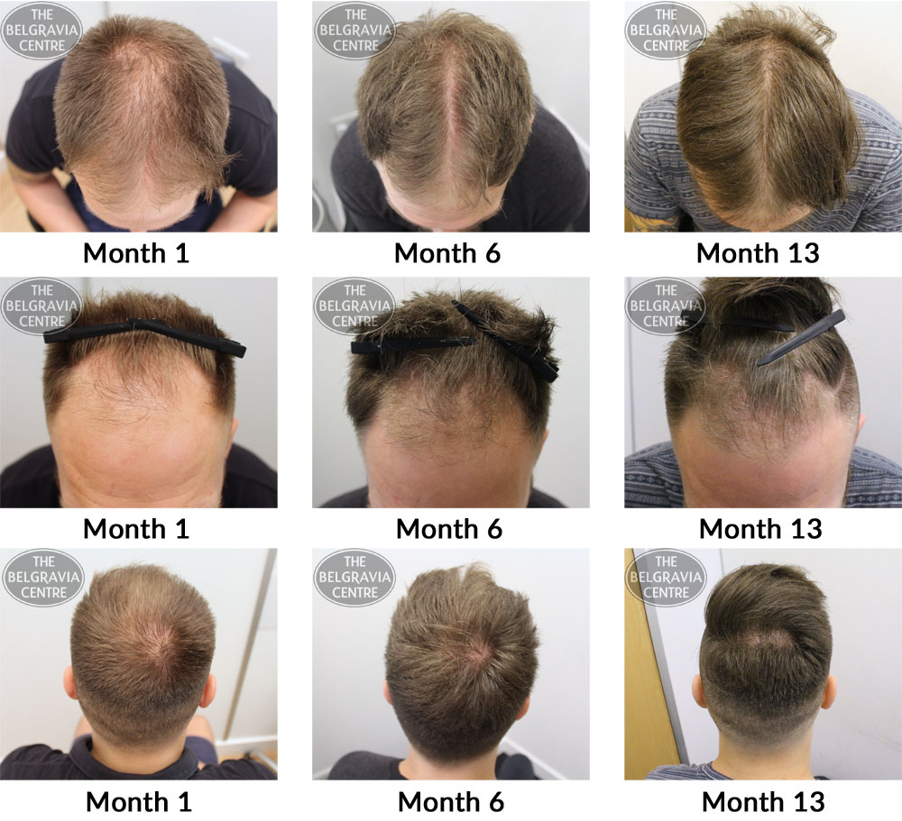Male-Pattern-Hair-Loss-The-Belgravia-Centre-07-09
