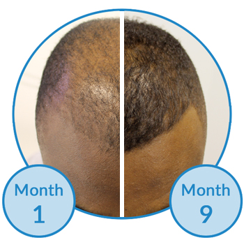Success-Story Male Pattern Hair Loss Treatment The Belgravia Centre