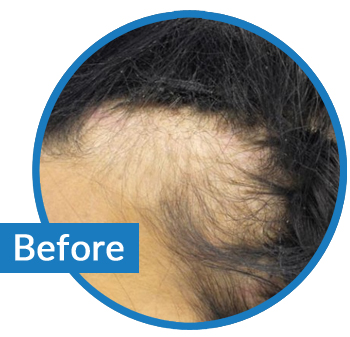 Example of Chemical Trauma Hair Loss - Before Image - Belgravia Centre Hair Loss Clinic London